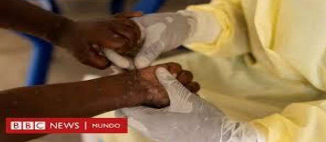 Expansión global de la variante de Mpox en Suecia y Pakistán
